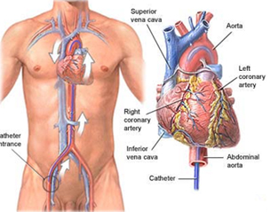 Coronary Angiogram India, Coronary Angiography India, Affordable Coronary Angiography