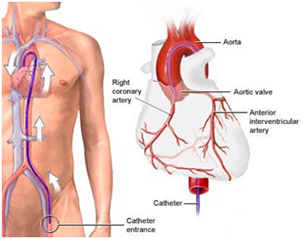 Coronary Angiography, Coronary Angiogram India, Affordable Coronary Angiography, Cost Coronary Angiography India