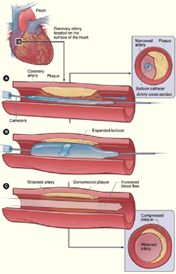 Angioplasty Surgery, Angioplasty Surgery India