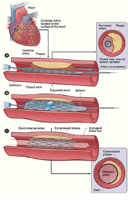 Angioplasty Surgery India, Angioprim, Heart Pain, Chest Pain, Alternative Medicine