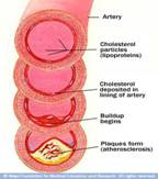 Coronary Artery Bypass Surgery, India CABG Surgery