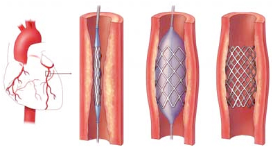 Coronary Stenting Surgery, Coronary Stening India, Drug Eluting Coronary Stenting Surgery India