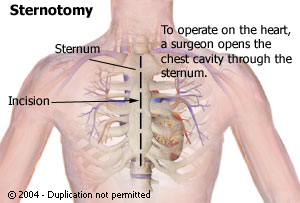 Heart Transplant Surgery, Information, Cardiac Transplantation, Artificial Heart Transplantation