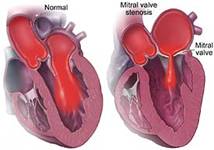 Mitral Valve Replacement Surgery, Mitral Valve Repair India