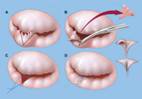 Mitral Valve Repair India, Balloon Mitral Valve Syndrome, Balloon Valvuloplasty