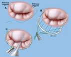 Balloon Mitral Valve Syndrome, Balloon Valvuloplasty, India Hospital Tour