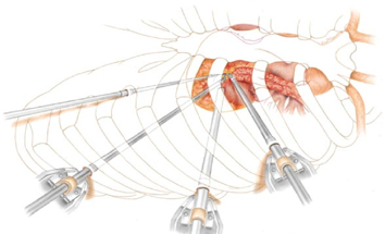 Mitral Valve Replacement Surgery, Balloon Mitral Valve Syndrome, Heart Valve Repair Surgery