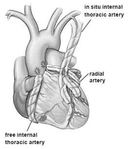 On Pump Heart Surgery, India CABG Surgery