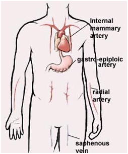 India CABG Surgery, On Pump Heart India