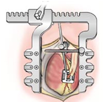 On Pump Heart Surgery, On Pump Heart India, On-Pump Cardiothoracic Surgery