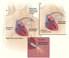 Pacemaker Permanent Implant, Pacemaker Implant India, Pacemaker