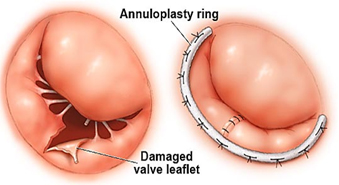 Pediatric Aortic Valve Replacement, Aortic Valve Surgery India