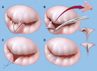 Pediatric Aortic Valve Replacement, Aortic Valve Disease, Regurgitation