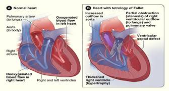 Tetralogy Of Fallot, Tetralogy Of Fallot Surgery India, TOF, Pediatric Tetralogy Of Fallot