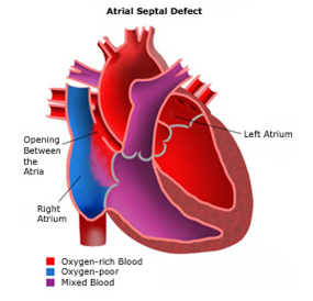 Pediatric Heart Surgery, Pediatric Heart Surgery India