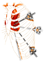 CABG Surgery India, Surgical Robot, Bypass Surgery, Cardiac Surgery