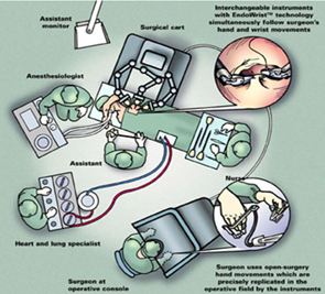 Robotic Heart Bypass, Surgical Robot, Bypass Surgery, Coronary Artery Bypass Surgery