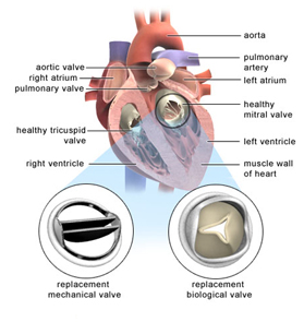 Valve Replacement India, Aortic Valve Replacement, Cardiac Bypass Surgery