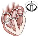 Aortic Valve Replacement