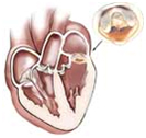 Valve Replacement, Cardiac Bypass Surgery