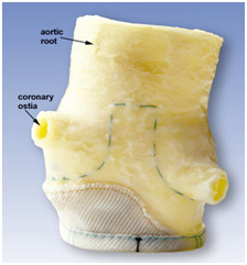 Valve Replacement, Valve Replacement India, Cardiac Surgery