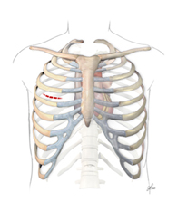 Valve Replacement India, Aortic Valve Replacement