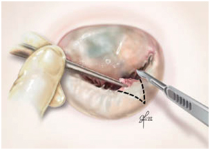 Valve Replacement, Aortic Valve Replacement