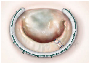 Valve Replacement, Cardiac Surgery