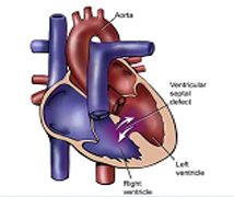 Ventricular Septal Defect Surgery, Ventricular Septal Defect India, Ventricular Septal Defect