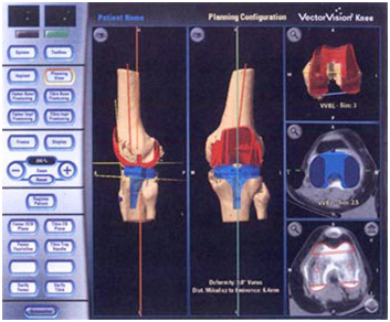 Computer Assisted Hip Replacement Surgery India, Hip Replacement