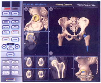 Computer Assisted Hip Replacement Surgery, Computer Assisted Hip Replacement Surgery India, Computer Assisted Hip Replacement Surgery abroad