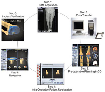 Computer Assisted Hip Replacement Surgery abroad, Hip Replacement