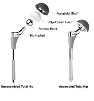 Computer Navigation Hip Replacement, acetabular Component Position, Computer Navigation