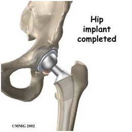 acetabular Component Position, Computer Navigation