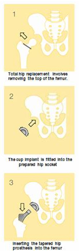 Computer Navigation assisted Hip Replacement India, Computer Navigation