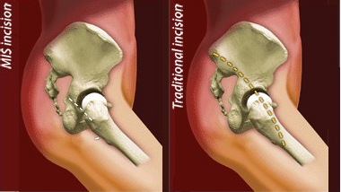 acetabular Component Position, Computer Navigation