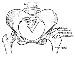 Hip Arthritis,  Common Hip Problem, Hip Arthritis India, Information About Hip Arthritis