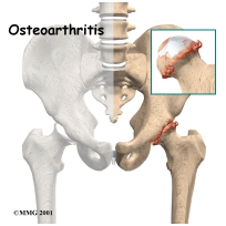 Hip Replacement Implant, Hip Replacement Implant India, Hip Replacement