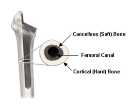 Hip Replacement Surgery India, Hip Replacement, Hip Arthroplasty, Hip Fracture Treatment