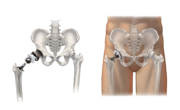 Hip Replacement Surgery India, Joint