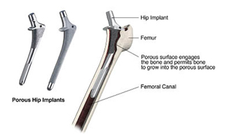 Hip Replacement India, Joint, Joint Disease, Hip Replacement, Hip Arthroplasty, Hip Joint