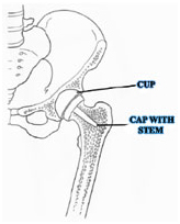 Birmingham Hip Resurfacing Stem Surgery, Hip Resurfacing Surgery India