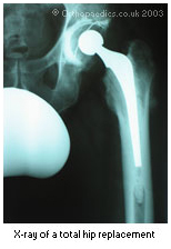 Hip Arthroplasty, Hip Arthroplasty India, Hip Replacement, Review Of Hip Arthroplasty