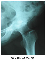 Hip Arthroplasty, Review Of Hip Arthroplasty, Definition Of Hip Arthroplasty, Worn Out Hips