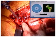 Hip Resurfacing Computer Assisted, Hip Resurfacing