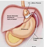 Bariatric Surgery India, Hospital For Laparoscopic Surgery, Hospital Bariatric Surgery