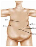 Hospital Bariatric Surgery, Minimally Invasive Surgery India