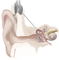 Cochlear Implant Hospital India Centre, Cochlear Implant in India centre, Cochlear Implant Hospital, Cochlear Implant Hospital In Delhi