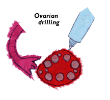 Ovarian Drilling Treatment India, India Cost Ovarian Drilling Treatment