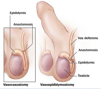 How Is A Vasectomy Performed. Affordable Vasectomy Reversal